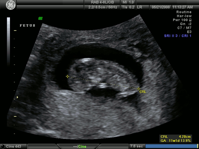 Ultrasonido del primer mes de embarazo - Imagui