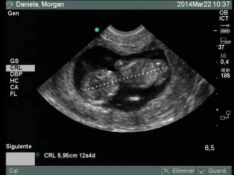 Ultrasonido de 3 meses de embarazo. - YouTube