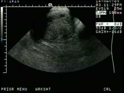 Ultrasonido 6 semanas Embrion - YouTube