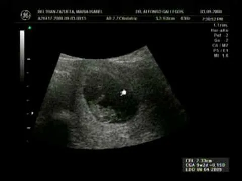 Ultrasonido de un mes de embarazo - Imagui