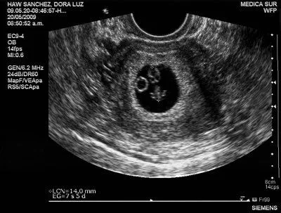 Ultrasonido 5 semanas de embarazo - Imagui