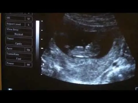 Ultrasonido a las 10 semanas de embarazo. - YouTube