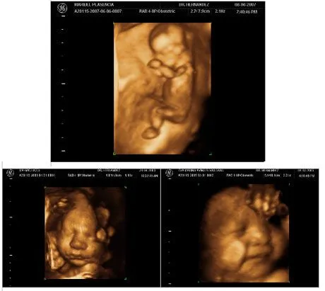 Ultrasonido de 6 meses de embarazo - Imagui