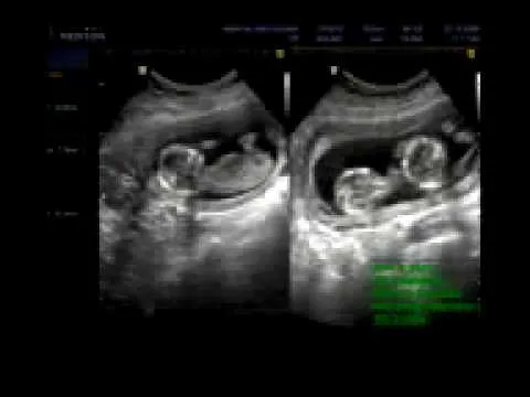 Ultrasonidos de gemelos de 4 meses - Imagui