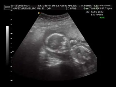 Ultrasonido tres meses de embarazo - Imagui