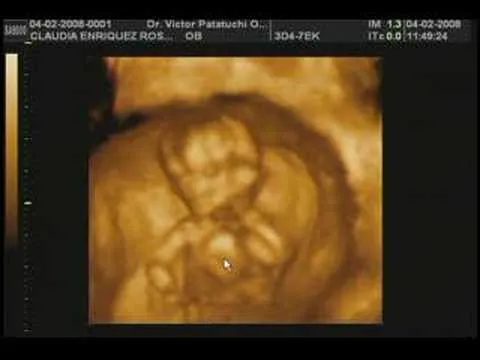 USG 4D embarazo de 13 semanas - YouTube