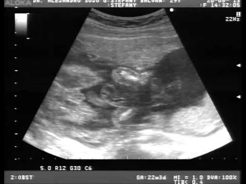 Video del 5º Ultrasonido, el bebé ya se mueve mucho. - YouTube