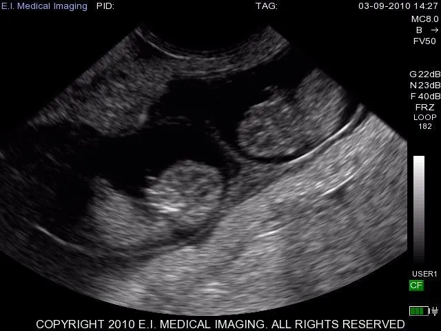 Imágenes de ultrasonidos de 2 meses gemelos - Imagui