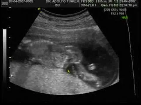Ultrasonido de tres meses de embarazo - Imagui