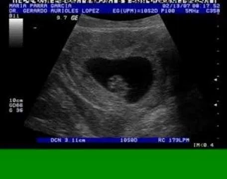 10 semanas (ultrasonido) - YouTube