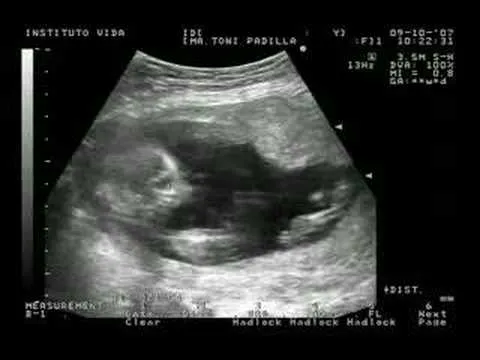 15 SEMANAS.BEBE EN UTERO. VISTO POR ECOGRAFIA - YouTube