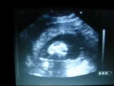 18 semanas de embarazo ultrasonido - YouTube