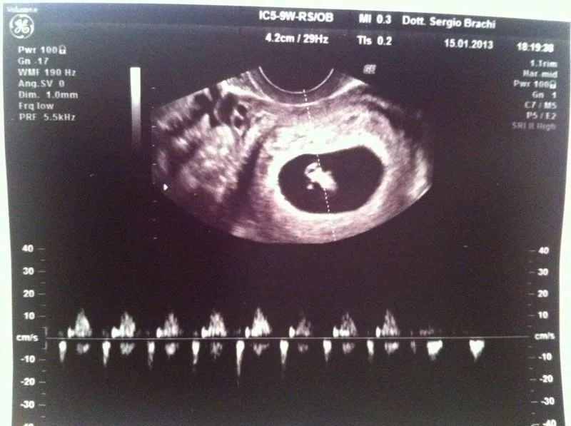 1a Ecografia: 7 semanas | Piezecitos