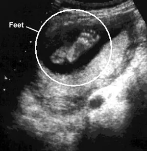 Ecografía del pie del bebé, en la semana 20 de gestación. Ecografía del pie del bebé, en la semana 20 de gestación.