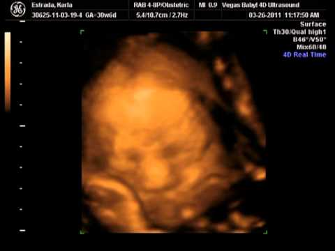 31 SEMANAS DE EMBARAZO ULTRASONIDO 4D - YouTube 31 SEMANAS DE EMBARAZO ULTRASONIDO 4D - YouTube