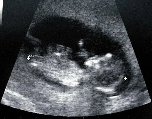 Ecografía 13 semanas | Flickr - Photo Sharing!