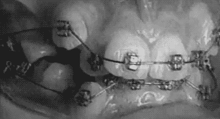 4CORN: lo que sucede cuando tienes brackets 4CORN: lo que sucede cuando tienes brackets