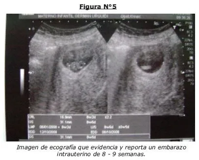 Gaceta Médica Boliviana - Embarazo heterotópico. Un suceso insólito