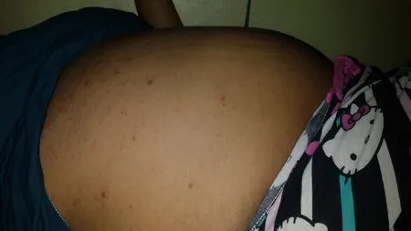 Acne en la panza :( - Bebés de Diciembre 2014 - BabyCenter