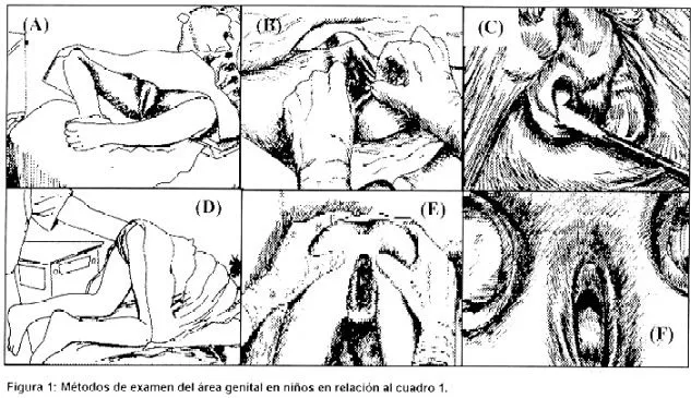 Acta Pediátrica Costarricense - Vulvovaginitis inespecífica Acta Pediátrica Costarricense - Vulvovaginitis inespecífica