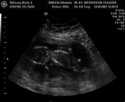 AMY AMY - Ecografia, ultrasonido 18 semanas 6 dias - Sexo del bebe ...