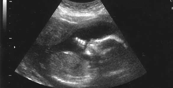 Un analisis de sangre permite conocer el sexo del feto a las 7 ...