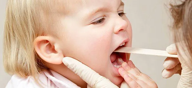 Angina y faringitis. La inflamación de la garganta de los niños