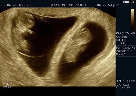 Aventuras de papás prematuros: Embarazo con mellizos Bicoriales
