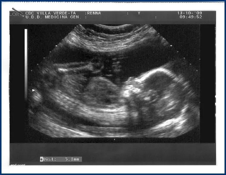 Ecografia de 8 mese - Imagui