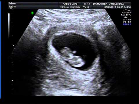 bebe 10 semanas de gestación - YouTube