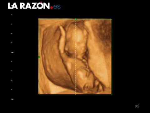 Bebé de 14 semanas de gestación. Ecografía en 3D ofrecidas por el ...