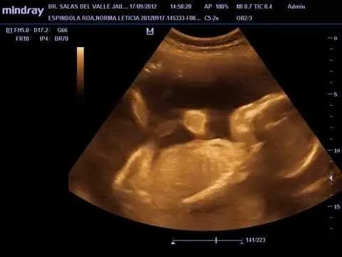 BEBE DE 24 SEMANAS DE GESTACION E R N - YouTube BEBE DE 24 SEMANAS DE GESTACION E R N - YouTube