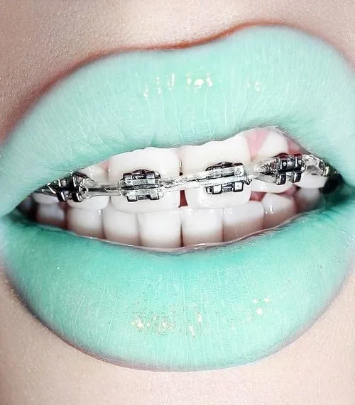 Besos con brackets tumblr - Imagui