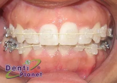 Blog Ortodoncia Dentiplanet: agosto 2009