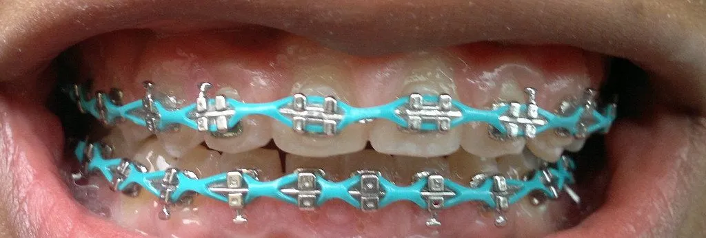 Braces 10 Months | Flickr - Photo Sharing!
