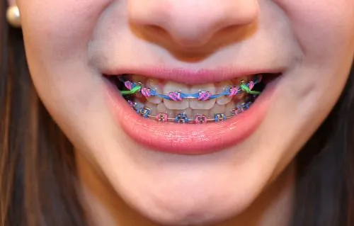 Braces Colors: Braces Colors Christmas Ideas For Guys Braces Colors: Braces Colors Christmas Ideas For Guys