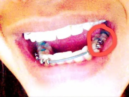 Day 4: Attempting Solid Food | Braces Diary: Brace Yourself Day 4: Attempting Solid Food | Braces Diary: Brace Yourself