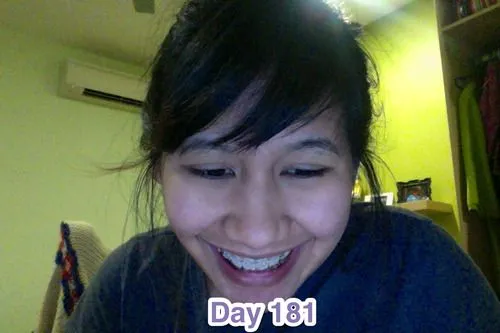 Braces Diary: Brace Yourself - Day 181: Ceramic Braces - Day 181 ... Braces Diary: Brace Yourself - Day 181: Ceramic Braces - Day 181 ...