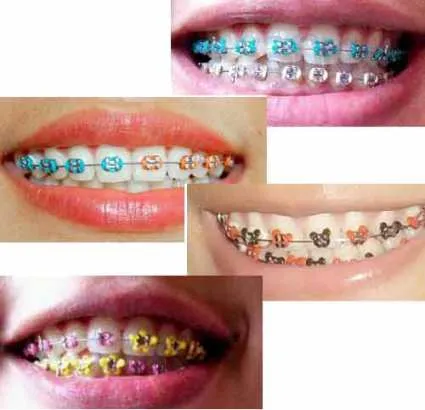 Colores de brackets para hombre - Imagui