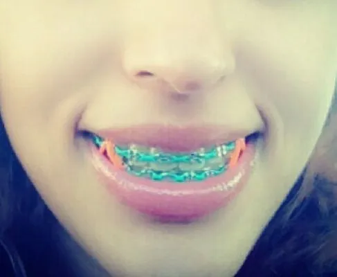 Braces on Pinterest | Braces Colors, Dental Art and Dental