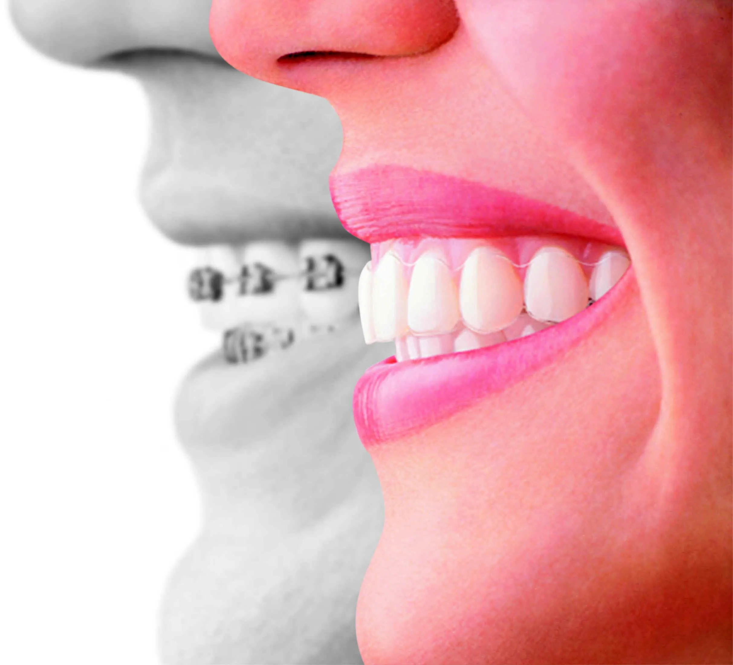 Brackets