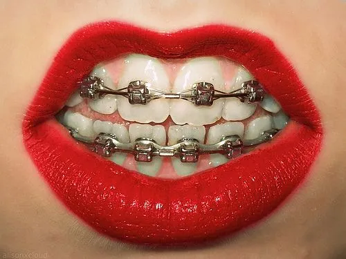 Con brackets a los 30, ¿y...? | @BeBloggera Con brackets a los 30, ¿y...? | @BeBloggera