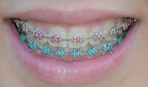 Con brackets a los 30, ¿y...? | @BeBloggera