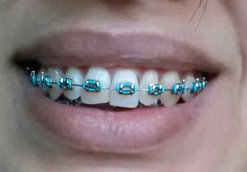 Brackets azules - Imagui