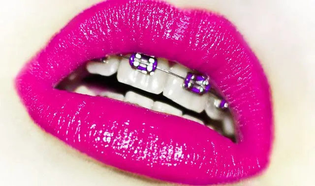 Labios con brackets bonitos - Imagui