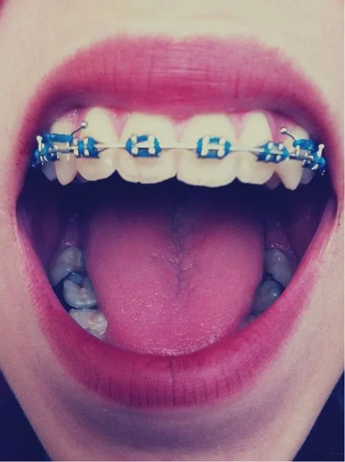 Brackets de colores fosforescentes - Imagui