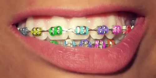 Brackets de colores fosforescentes - Imagui