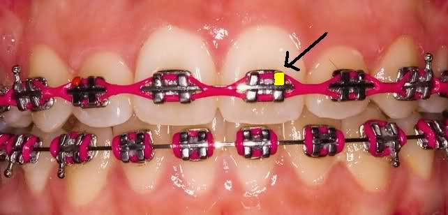 Brackets de colores