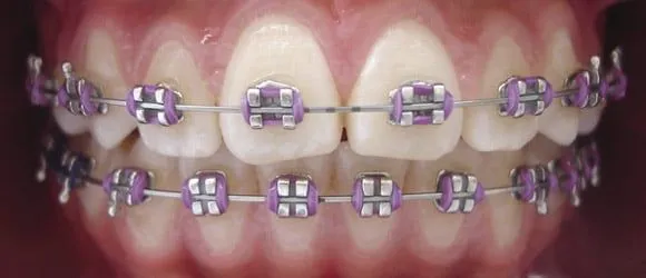 Brackets de colores