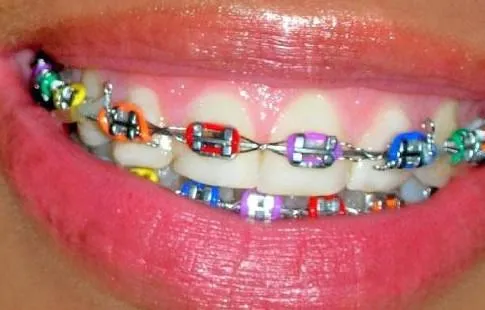 Brackets de colores